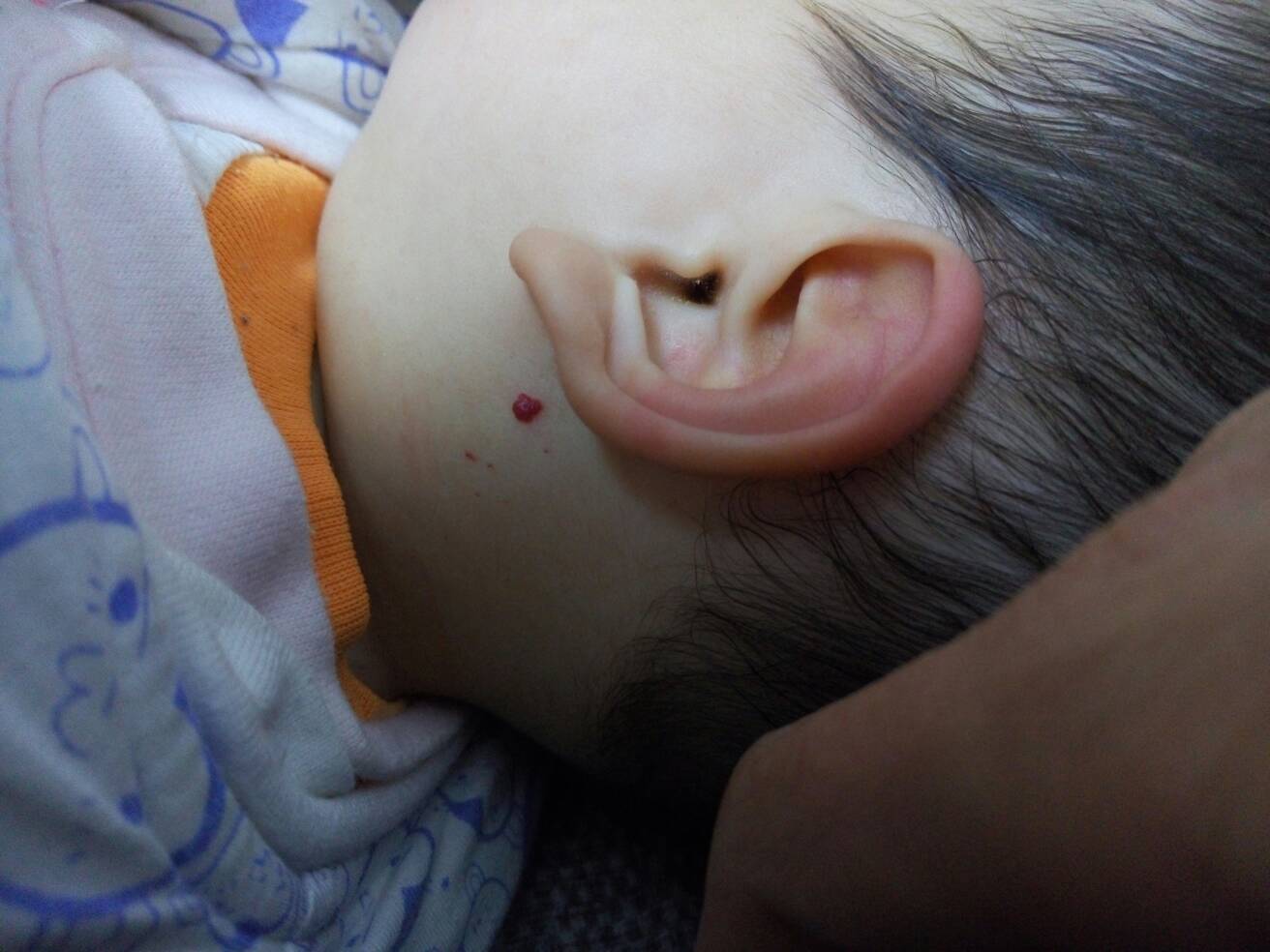 新生儿正常红痣的图片图片