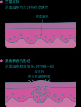 手臂长黑色痣凸起(手臂长黑色痣凸起怎么回事)