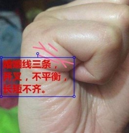 手掌婚姻线疼痛(婚姻线在手掌侧面很短)