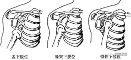 10岁右边锁骨断裂导致长短肩(锁骨断了自己会长好吗?多久胳膊会举起来?)